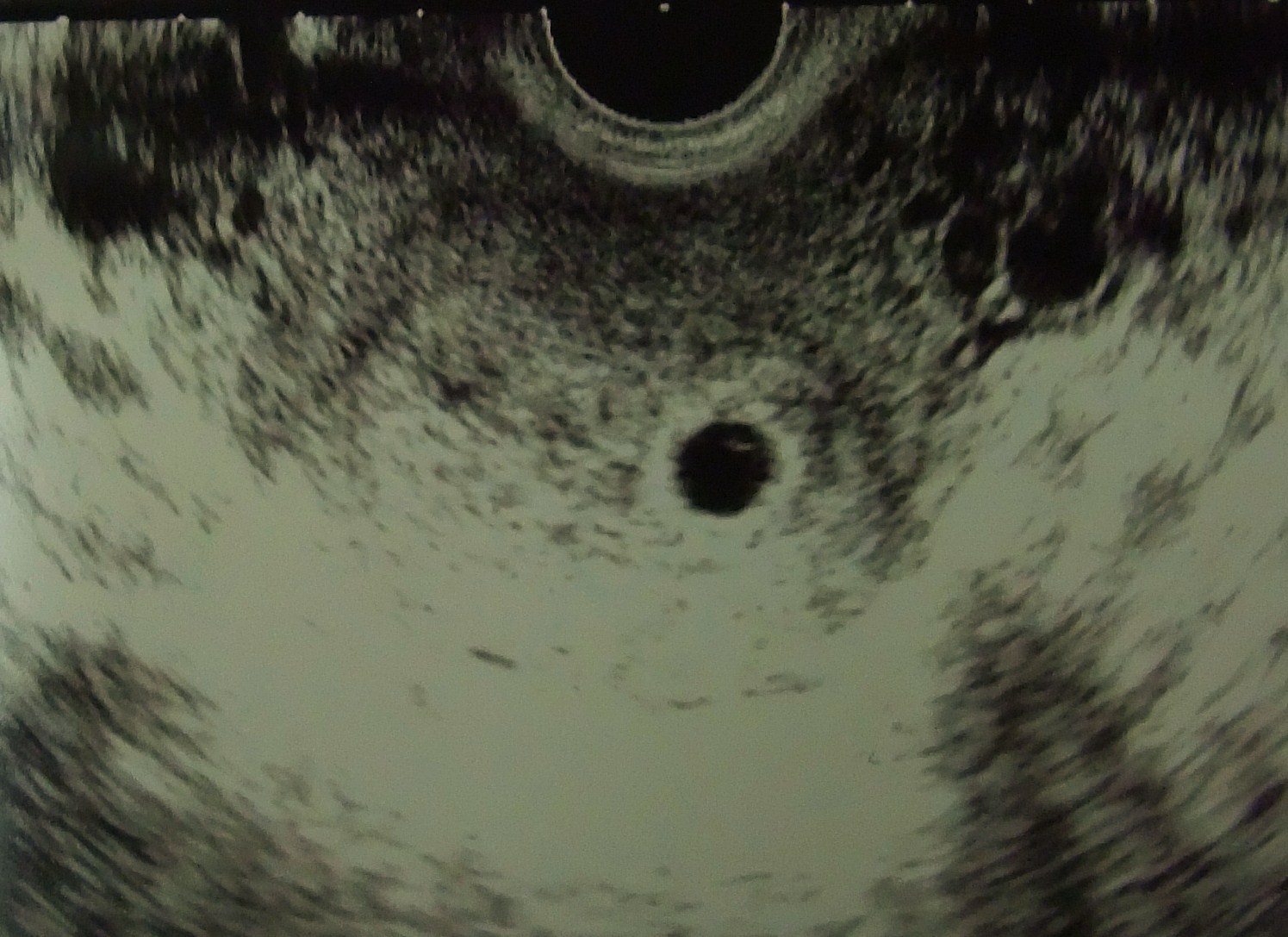 超音波検査（エコー）で子宮内に正常に妊娠しているかを確認します。
